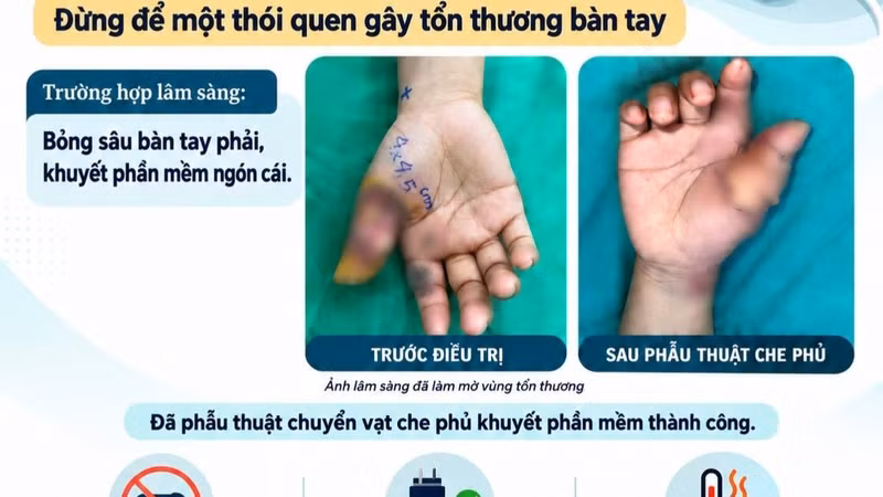 Bệnh nhân bỏng sâu bàn tay do điện thoại nổ khi sạc