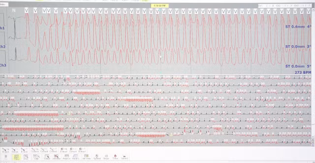 Holter điện tim của người bệnh. Ảnh BV
