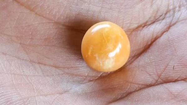 Nhưng cô gái nghèo sau đó ngạc nhiên khi nhận ra đây thực chất là một viên ngọc trai Melo có đường kính 1,5 cm, nặng 6 gram. Viên ngọc ốc này có thể có giá lên tới hàng chục nghìn bảng Anh (tương đương hàng trăm triệu đồng).