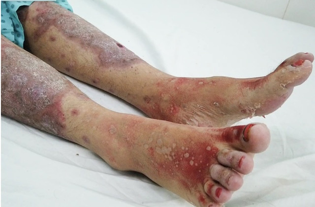 Uống thực phẩm chức năng, cô gái ở Lâm Đồng nhiễm độc nặng Uong thuc pham chuc nang, co gai o Lam Dong nhiem doc nang