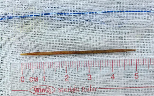 Nội soi gắp tăm xỉa răng dài 5cm cắm sâu vào tá tràng bé trai Noi soi gap tam xia rang dai 5cm cam sau vao ta trang be trai