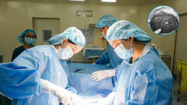 Đau bụng dữ dội, cơ thể tái xanh đi khám phát hiện u buồng trứng bị hoại tử to như quả bưởi Dau bung du doi, co the tai xanh di kham phat hien u buong trung bi hoai tu to nhu qua buoi