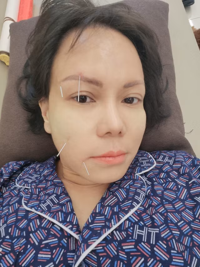 Việt Hương bị lệch mặt, phải châm cứu vì đóng phim ma ảnh 3