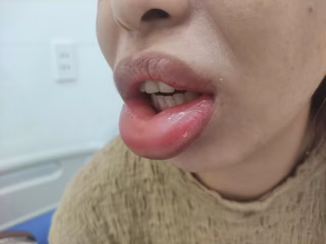 Tiem moi, nang nguc lam dep: Hau qua kho luong khi toi cac tham my 'chui'