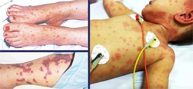 Trẻ em là đối tượng dễ mắc não mô cầu