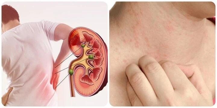 Khi chức năng thận suy giảm, có thể xuất hiện tình trạng da khô và ngứa. Ảnh: Internet.