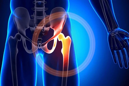 Thoái hóa khớp khiến cho người bệnh đau đớn khi đi lại