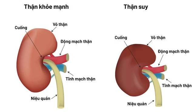 Không ít người trẻ chủ quan với những thay đổi nhỏ của cơ thể mà không biết đó có thể là dấu hiệu cảnh báo suy thận.