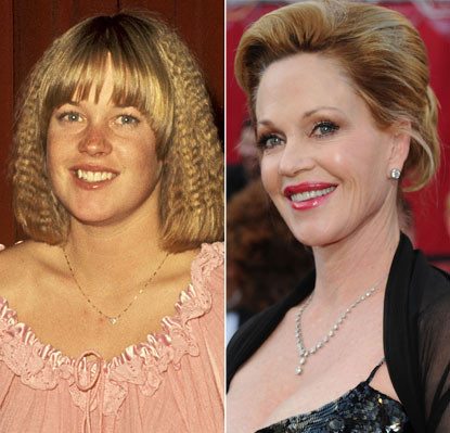 Khuôn mặt của nữ diễn viên Melanie Griffith năm 1977, lúc cô mới 20 tuổi khác hẳn với bây giờ, sau vài lần dao kéo.