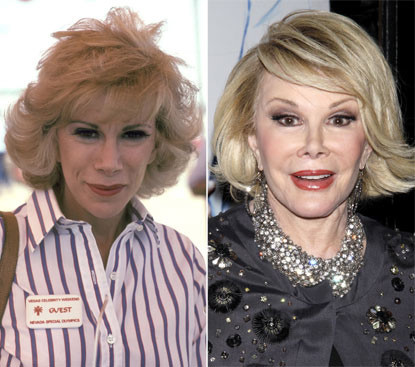 So hình ảnh nữ diễn viên quá cố Joan Rivers trước đây khi chưa dao kéo (năm 1982) với hình ảnh sau này của bà khi đã thực hiện tổng cộng 739 lần thẩm mỹ thì thấy hoàn toàn là hai con người khác nhau.