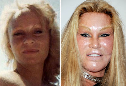 Jocelyn Wildenstein, một nhân vật nổi tiếng ở New York sau nhiều lần cố tình phẫu thuật thẩm mỹ để có khuôn mặt thật giống mèo, theo ý thích của chồng cũ với chi phí tới 4 triệu USD. Kể từ đó Jecelyn được mệnh danh là Miêu nữ.