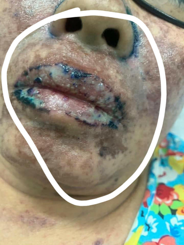 Một phụ nữ suýt mất mạng khi điều trị ở Bệnh viện Sài Gòn ITO - Hình 2 Mot phu nu suyt mat mang khi dieu tri o Benh vien Sai Gon ITO-Hinh-2