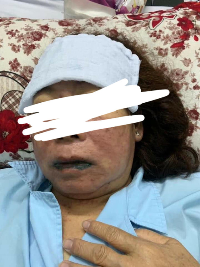 Một phụ nữ suýt mất mạng khi điều trị ở Bệnh viện Sài Gòn ITO Mot phu nu suyt mat mang khi dieu tri o Benh vien Sai Gon ITO
