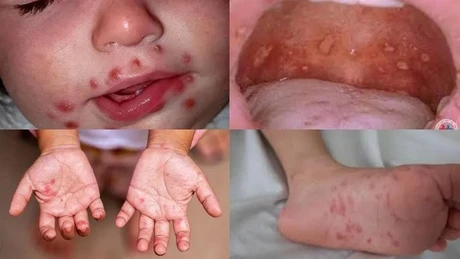 Trẻ mắc bệnh tay chân miệng