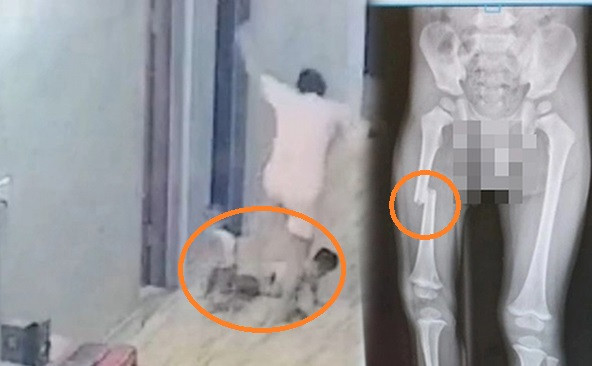 Mẹ đạp gãy xương đùi con: Cái giá cho sự nóng giận? Me dap gay xuong dui con: Cai gia cho su nong gian?