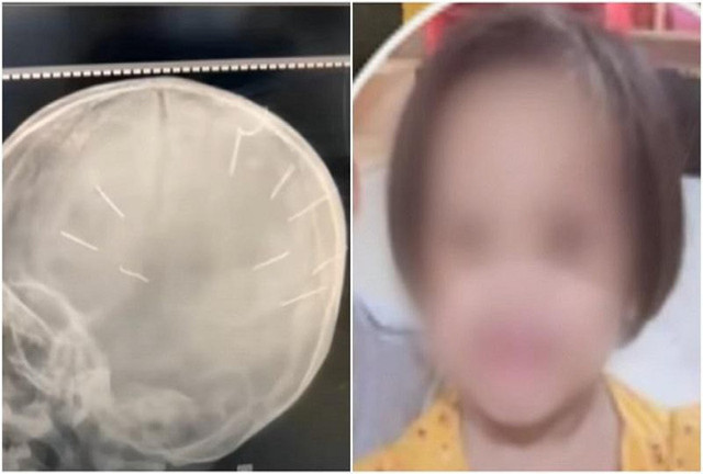 Lời kể của gã cha dượng đóng đinh vào đầu bé 3 tuổi - Hình 11 Loi ke cua ga cha duong dong dinh vao dau be 3 tuoi-Hinh-11