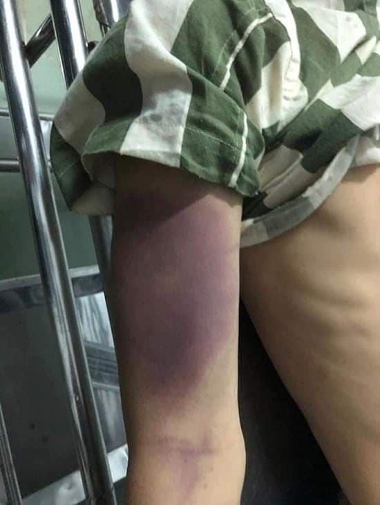 Nam thanh niên chết trong nhà tạm giữ công an ở Đồng Nai, khắp người bầm tím Nam thanh nien chet trong nha tam giu cong an o Dong Nai, khap nguoi bam tim