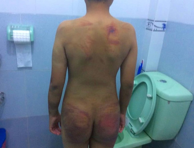 Thân thể bé trai 11 tuổi rướm máu, lở loét vì bị thầy chùa đánh đập dã man - Hình 5 Than the be trai 11 tuoi ruom mau, lo loet vi bi thay chua danh dap da man-Hinh-5