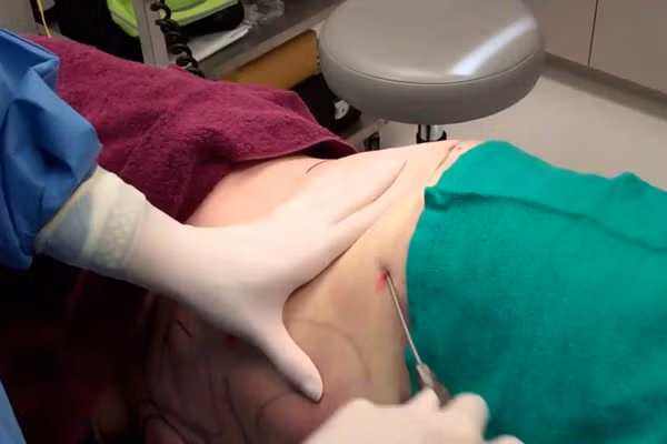 Hut mo bung tai tham my vien, nguoi phu nu 58 tuoi nhap vien cap cuu