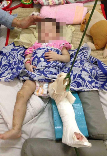 Bé gái 1 tuổi bị mẹ nuôi bạo hành thương tích kinh hoàng - Hình 2 Be gai 1 tuoi bi me nuoi bao hanh thuong tich kinh hoang-Hinh-2