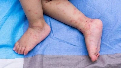 Bệnh tay chân miệng do virus đường ruột gây ra