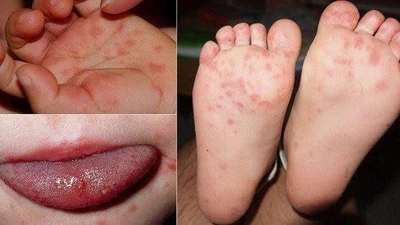 Hà Nội ghi nhận ca mắc bệnh tay chân miệng tăng mạnh, tiềm ẩn biến chứng nặng