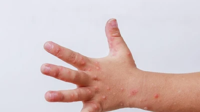 Bệnh tay chân miệng tăng mạnh ở TPHCM, bác sĩ cảnh báo gì?