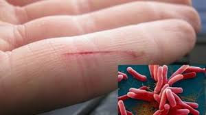 3 chị em tử vong vì nhiễm vi khuẩn 'ăn thịt người' 3 chi em tu vong vi nhiem vi khuan 'an thit nguoi'