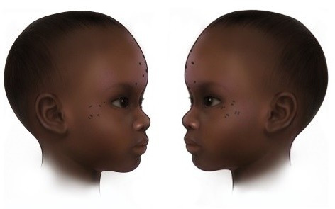 Ngoài ra, một giả thuyết khác cho rằng, việc xăm hình cho những đứa trẻ có thể vì mục đích y tế nhằm giúp chúng xoa dịu cơn đau đầu hoặc sốt. Ảnh: Mary Nguyen/UMSL.