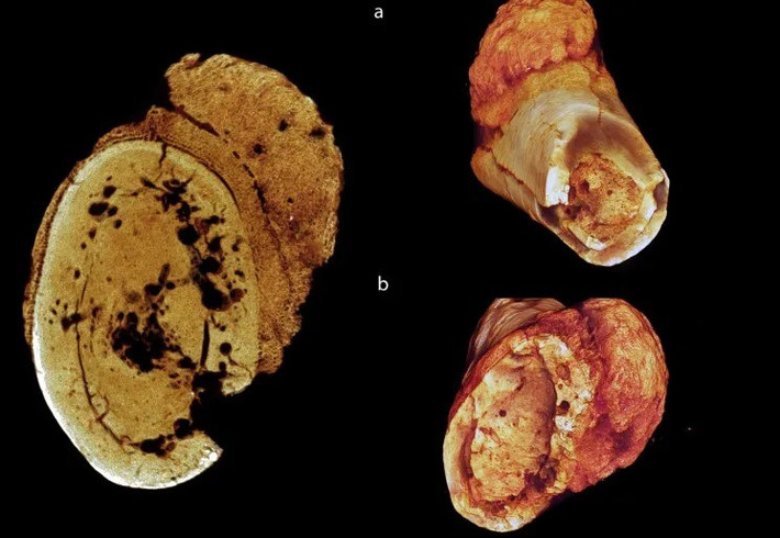 Theo Hiệp hội Ung thư Mỹ, ngày nay, osteosarcoma là một trong những bệnh ung thư xương phổ biến nhất ở người và có thể xảy ra ở mọi lứa tuổi nhưng thường gặp nhất ở trẻ em, thanh thiếu niên và người trẻ. Ảnh: Edward Odes Wits.