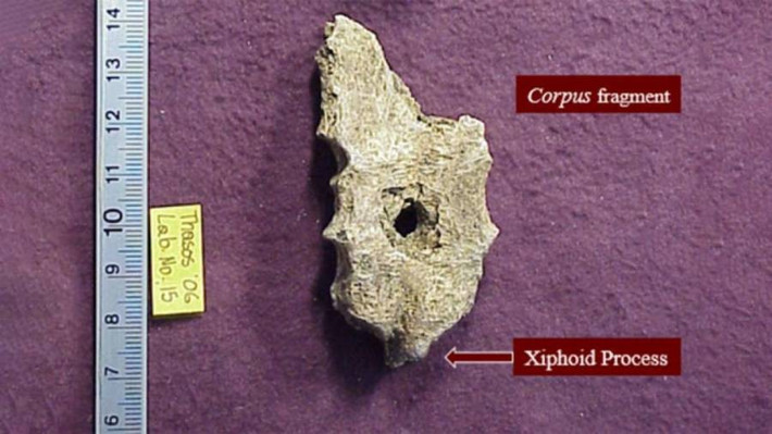 Khi một nhóm các nhà khảo cổ học phát hiện hài cốt của 57 người ở mọi lứa tuổi tại một địa điểm khai quật trên đảo Thasos của Hy Lạp, một thi hài thu hút sự chú ý của họ. Nguyên do là trên bộ hài cốt này có một lỗ gần như hình tròn hoàn hảo trên xương ức. Ảnh: Anagnostis Agelarakis/ Access Archaeology.
