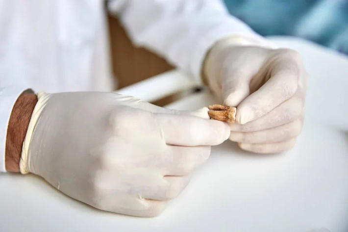 Kết quả cho thấy 4 người mang vi khuẩn Salmonella enterica - tác nhân gây bệnh sốt thương hàn phụ (paratyphoid), với triệu chứng chán ăn và nổi ban đỏ; 2 người khác nhiễm Borrelia recurrentis - vi khuẩn do chấy truyền, gây bệnh "sốt tái phát" đặc trưng bởi những cơn sốt cao lặp đi lặp lại. Ảnh: Claudio Centonze/European Commission.