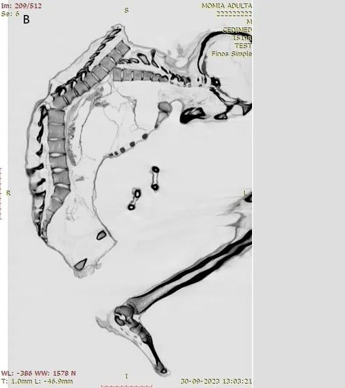 Trên xác ướp có nhiều bằng chứng về chấn thương do lực tác động mạnh cho thấy người đàn ông có thể đã thiệt mạng do đá lở hoặc sập hầm mỏ. Trong nghiên cứu mới công bố, các chuyên gia đã chụp CT và chụp X-quang để giải mã chi tiết những chấn thương nghiêm trọng có thể đã dẫn đến cái chết của người đàn ông trên. Ảnh: Francisco Garrido and Catalina Morales.