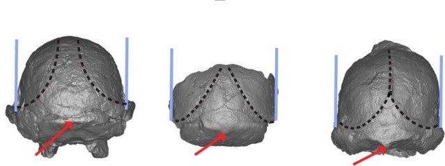 Sau khi tách khỏi lớp đá cứng, các chuyên gia gặp khó khăn trong việc xác định giới tính và niên đại của "Little Foot". Bộ xương hóa thạch này được cho có niên đại từ 2,6 đến hơn 3 triệu năm trước nhưng đến nay vẫn chưa thể xác định chính xác. Ảnh: Martin et al., Am. J. Biol. Anthropol. 2025.
