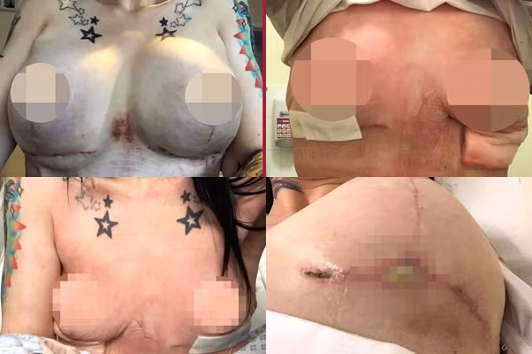 Kinh hoàng biến chứng sau nâng ngực của cô gái trẻ - Hình 2 Kinh hoang bien chung sau nang nguc cua co gai tre-Hinh-2