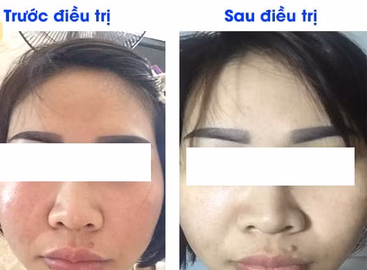 Trị nám ở spa, cô gái đau đớn mang ổ viêm trên mặt Tri nam o spa, co gai dau don mang o viem tren mat