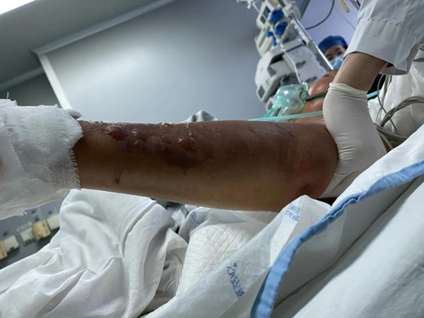 Dùng tay rửa cá, lão ngư nhiễm vi khuẩn 'ăn thịt người' - Hình 3 Dung tay rua ca, lao ngu nhiem vi khuan 'an thit nguoi'-Hinh-3