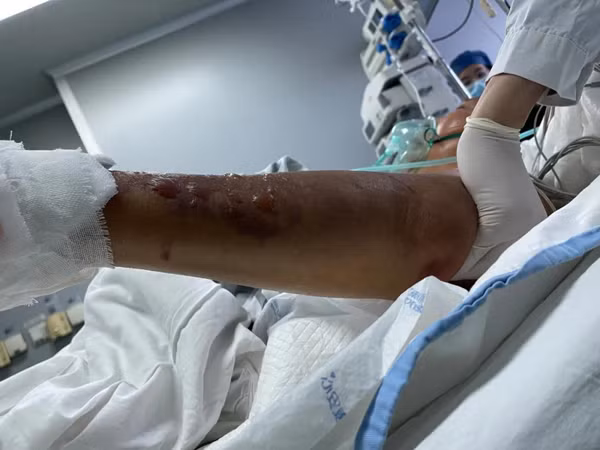 Dung tay rua ca, lao ngu nhiem vi khuan 'an thit nguoi'-Hinh-3