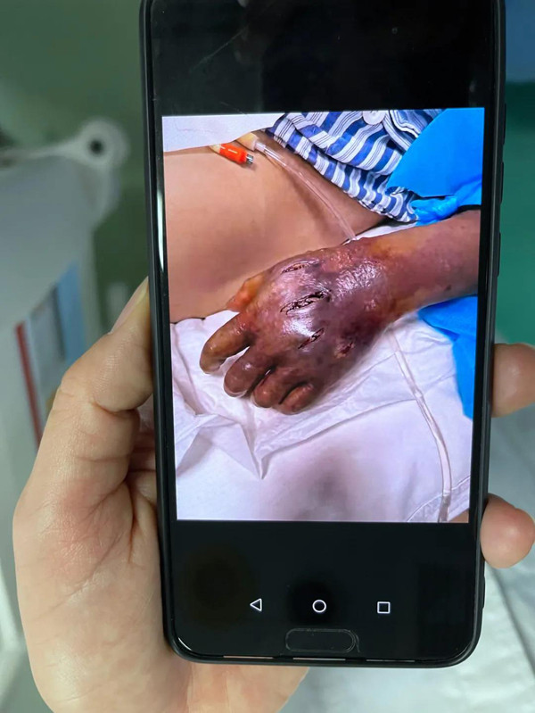 Dùng tay rửa cá, lão ngư nhiễm vi khuẩn 'ăn thịt người' - Hình 2 Dung tay rua ca, lao ngu nhiem vi khuan 'an thit nguoi'-Hinh-2