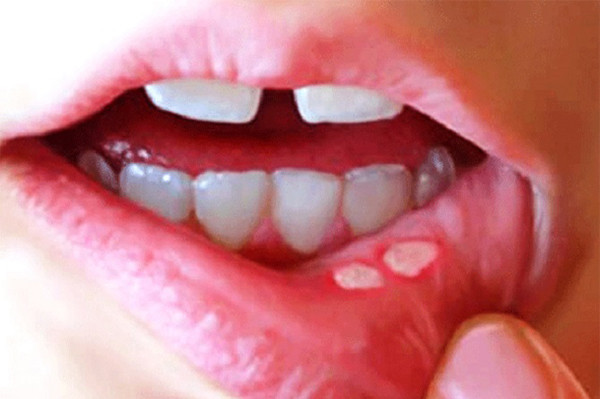 Những tổn thương “tiền ung thư” không được bỏ qua - Hình 10 Nhung ton thuong “tien ung thu” khong duoc bo qua-Hinh-10