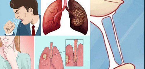Ngoài khói thuốc lá, còn loạt tác nhân hàng ngày cũng gây ung thư phổi - Hình 8 Ngoai khoi thuoc la, con loat tac nhan hang ngay cung gay ung thu phoi-Hinh-8