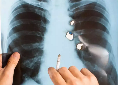 Ngoài khói thuốc lá, còn loạt tác nhân hàng ngày cũng gây ung thư phổi - Hình 2 Ngoai khoi thuoc la, con loat tac nhan hang ngay cung gay ung thu phoi-Hinh-2