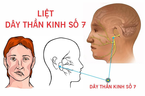 Bật điều hòa cả đêm, chàng trai bị biến dạng gương mặt - Hình 4 Bat dieu hoa ca dem, chang trai bi bien dang guong mat-Hinh-4