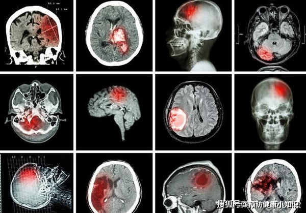 Bị nhồi máu não do nấu nướng bất cẩn - Hình 3 Bi nhoi mau nao do nau nuong bat can-Hinh-3