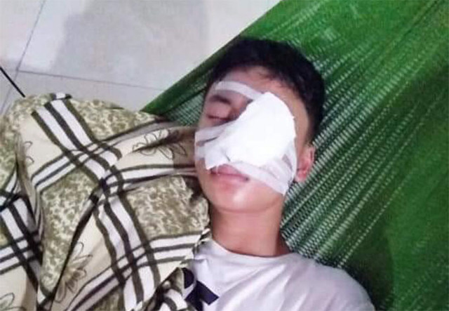 Bị chó dữ cắn nát mặt phải khâu hơn 20 mũi ở mặt Bi cho du can nat mat phai khau hon 20 mui o mat