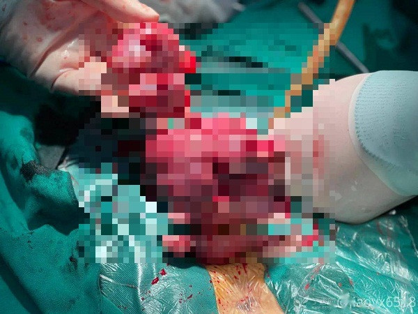 Tử cung 'mọc' u chi chít do trì hoãn điều trị Tu cung 'moc' u chi chit do tri hoan dieu tri