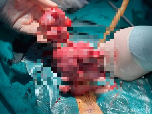 Tu cung 'moc' u chi chit do tri hoan dieu tri