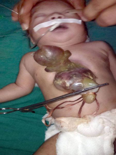 Hình ảnh sốc bé gái có trái tim nằm ngoài cơ thể - Hình 2 Hinh anh soc be gai co trai tim nam ngoai co the-Hinh-2