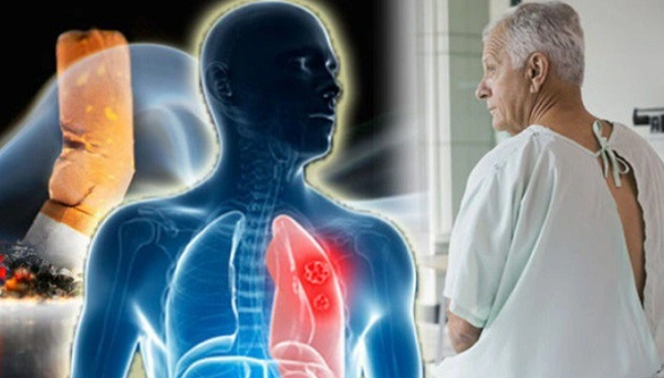 Thói quen sinh hoạt hàng ngày khiến nam giới dễ mắc ung thư hơn phụ nữ - Hình 4 Thoi quen sinh hoat hang ngay khien nam gioi de mac ung thu hon phu nu-Hinh-4