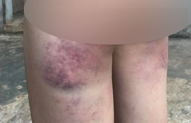 Cô giáo bị tố đánh bầm tím học sinh lớp 4 Co giao bi to danh bam tim hoc sinh lop 4